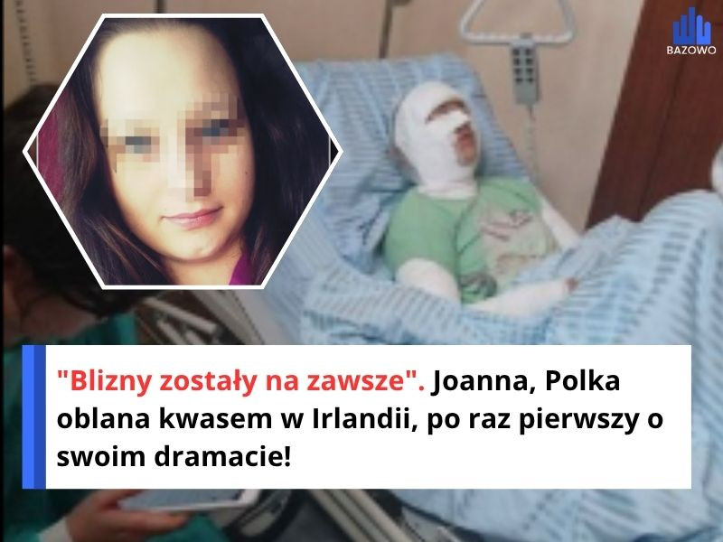 "Blizny zostały na zawsze". Joanna, Polka oblana kwasem w Irlandii, po raz pierwszy o swoim dramacie!